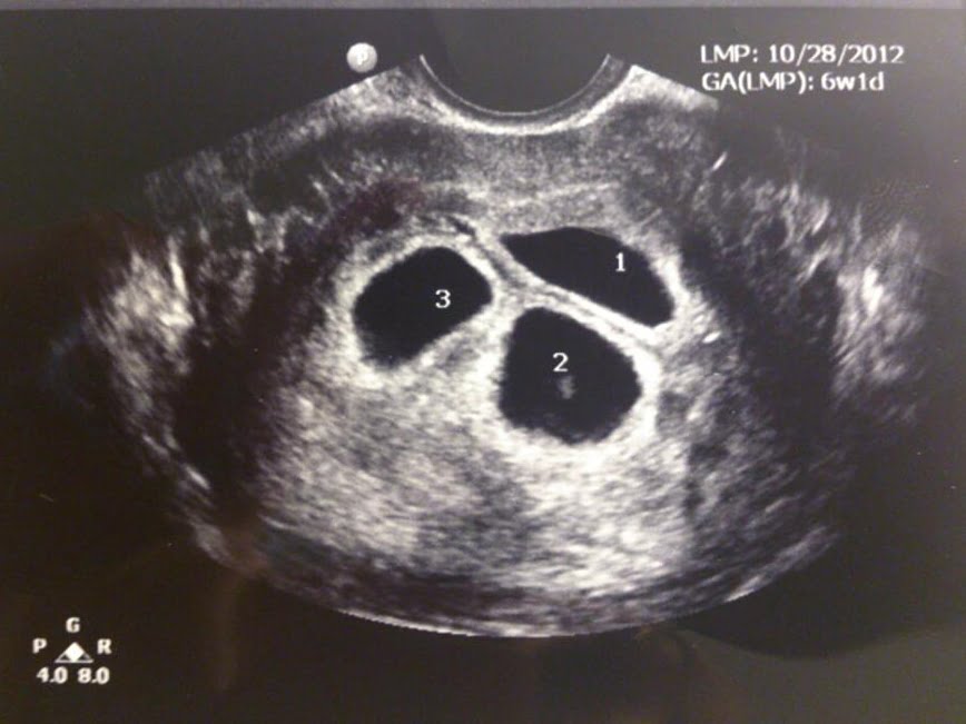 23 недели двойня. Многоплодная беременность УЗИ. УЗИ плода многоплодная беременность. Монохориальная моноамниотическая двойня УЗИ. УЗИ 6 недель беременности двойня однояйцевые.